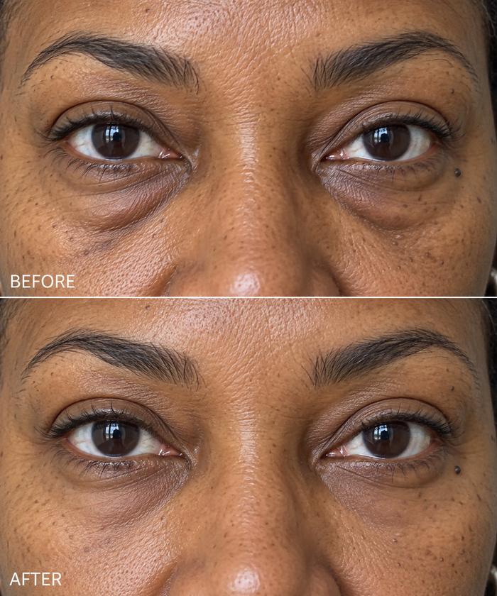 Before and after under-eye comparison 1